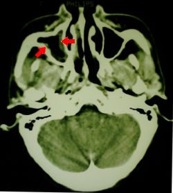 CT scan showing fairly subtle mucosal thickening in the right maxillary sinus. No fluid was present