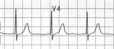 ECG: V4 showing short PR interval