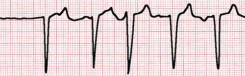 atrial fibrillation