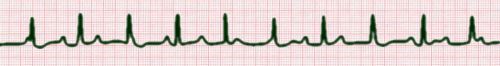 complete heart block