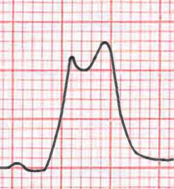 Acute myocardial infarction