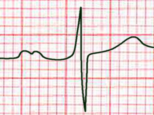 Std lead II: enlarged left atrium