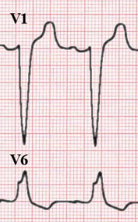 LBBB