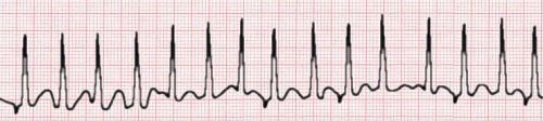 multifocal atrial tachycadia