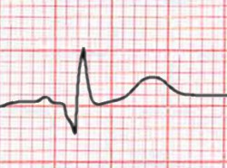 Q wave in inferior lead in old IMI