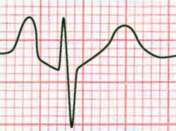 Std lead II: P pulmonale of RA enlargement