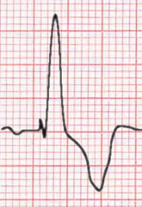 RBBB seen in V1