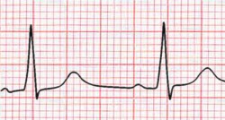 RV hypertrophy - tall R in V1