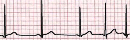 sinus arrhythmia