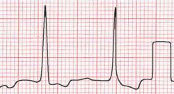 ECG calibration spike on right