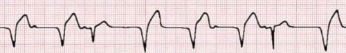 retrograde P waves