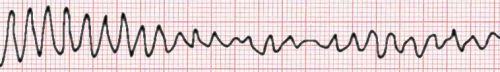 ventricular fibrillation