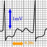 ECG voltage and timing