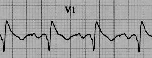 ECG after 2 days showing wide slurred R prime in V1