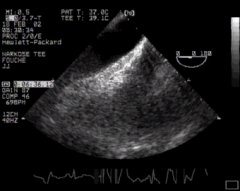 CLICK FOR VIDEO: Arch aorta lax view