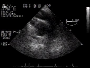 CLICK FOR VIDEO: Ascending aorta SAX view