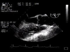 CLICK FOR VIDEO: ascending aorta (longitudinal)