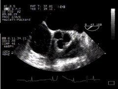 CLICK FOR VIDEO: aortic valve short axis