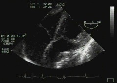 CLICK FOR VIDEO: long axis view (deep transgastric)