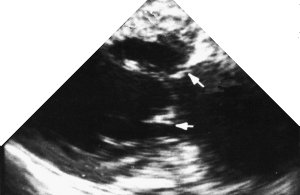 echo: 2-chamber view (longitudinal)