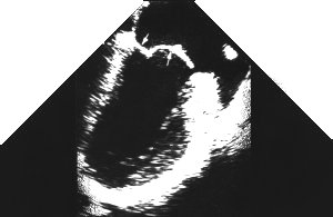 echo: mid oesophageal left atrial appendage (longitudinal)