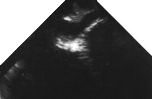 echo: coronary sinus view (mid-oesophageal)