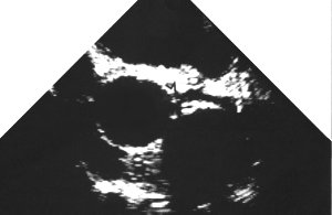 echo: left coronary artery origin (basal)