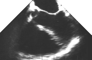 echo: five chamber view (mid-oesophageal)