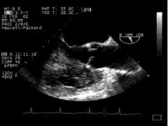 Echo STILL: left ventricular outflow tract  (longitudinal)