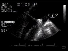 CLICK FOR VIDEO: mid oesophageal 2 chamber view  (longitudinal)