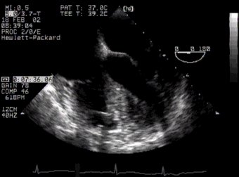 CLICK FOR VIDEO: four chamber view (mid-oesophageal)