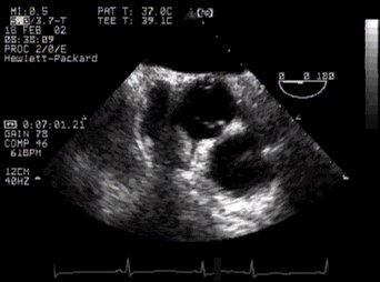 right coronary artery