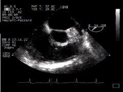 CLICK FOR VIDEO: right ventricular outflow (longitudinal)
