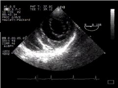 CLICK FOR VIDEO: transgastric view of mitral valve