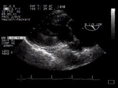 CLICK FOR VIDEO: long axis view (transgastric)