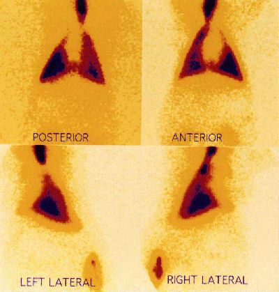 V/Q scan showing jet nebuliser deposition