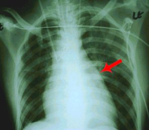 A rather poor quality chest x-ray of the patient,
 showing a prominent pulmonary artery segment
