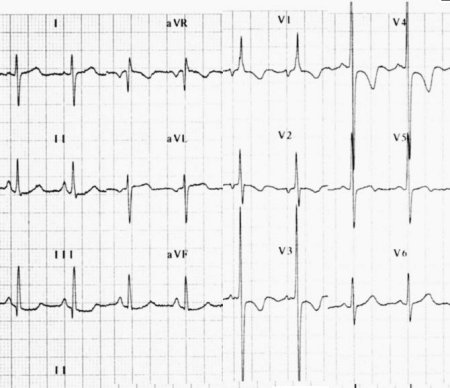 The Electrocardiogram, showing features of severe chronic
pulmonary hypertension