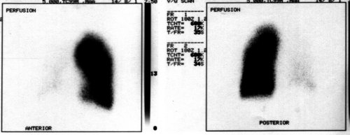 Perfusion scan, showing almost complete obliteration
of pulmonary arterial supply to the right lung