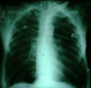 Chest x-ray after recruitment maneuver